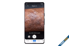 Google Lens ค้นหาสภาพผิวหนังที่คล้ายกันจากภาพได้แล้ว