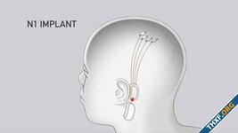 Neuralink สาธิตการทำงานชิปเชื่อมต่อสมองกับคอมพิวเตอร์ จากผู้ทดสอบคนแรก